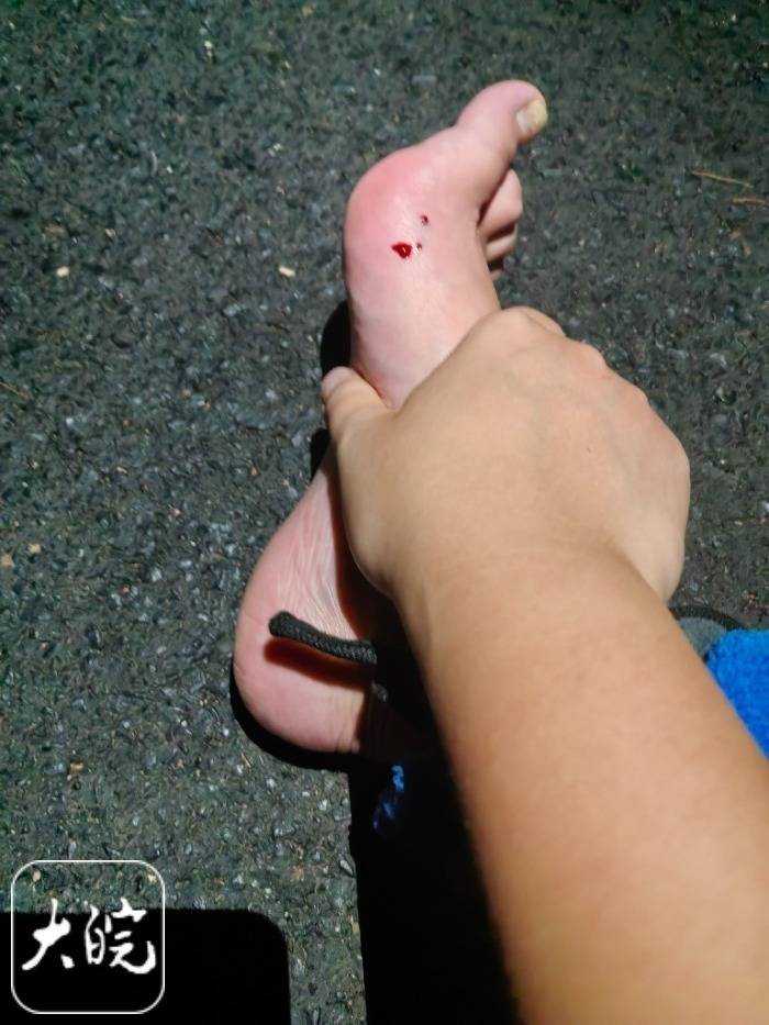 意大利甲组联赛_合肥一市民夜爬大蜀山被毒蛇咬伤 公园管理处呼吁：尽量避免夜间登山